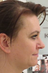 PRZED METAMORFOZA PRAWY PROFIL 1 BEAUTY CENTER